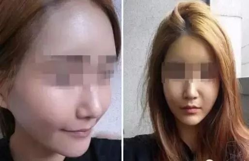 明星玻尿酸